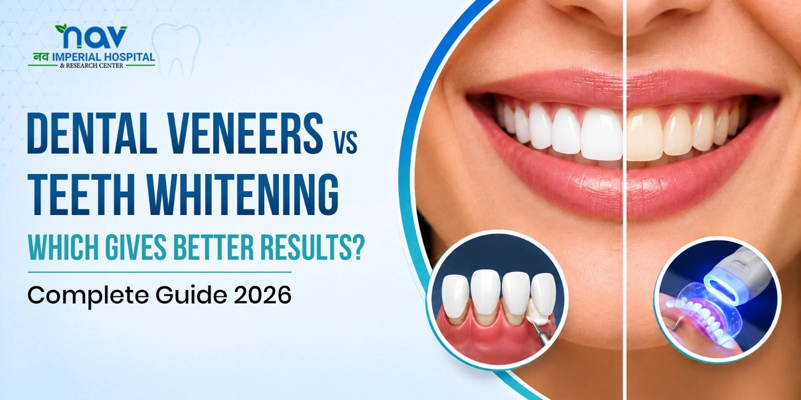 Dental veneers vs teeth whitening comparison
 