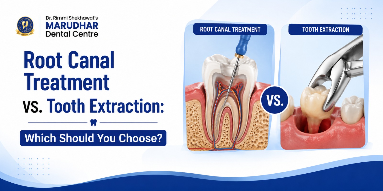 Root Canal Treatment vs Tooth Extraction comparison by Marudhar Dental Clinic Jaipur 