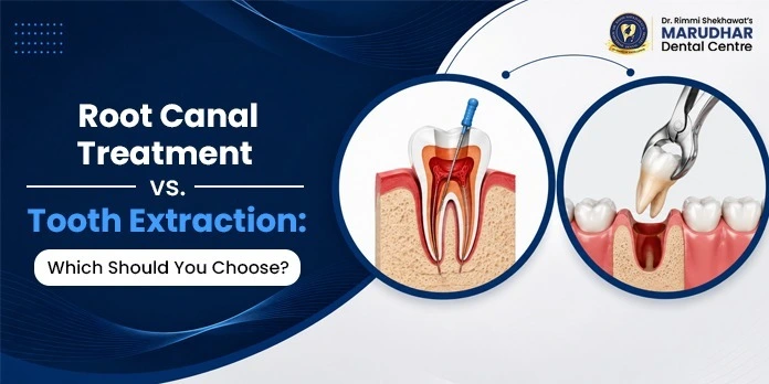 Root Canal Treatment vs Tooth Extraction comparison by Marudhar Dental Clinic Jaipur 