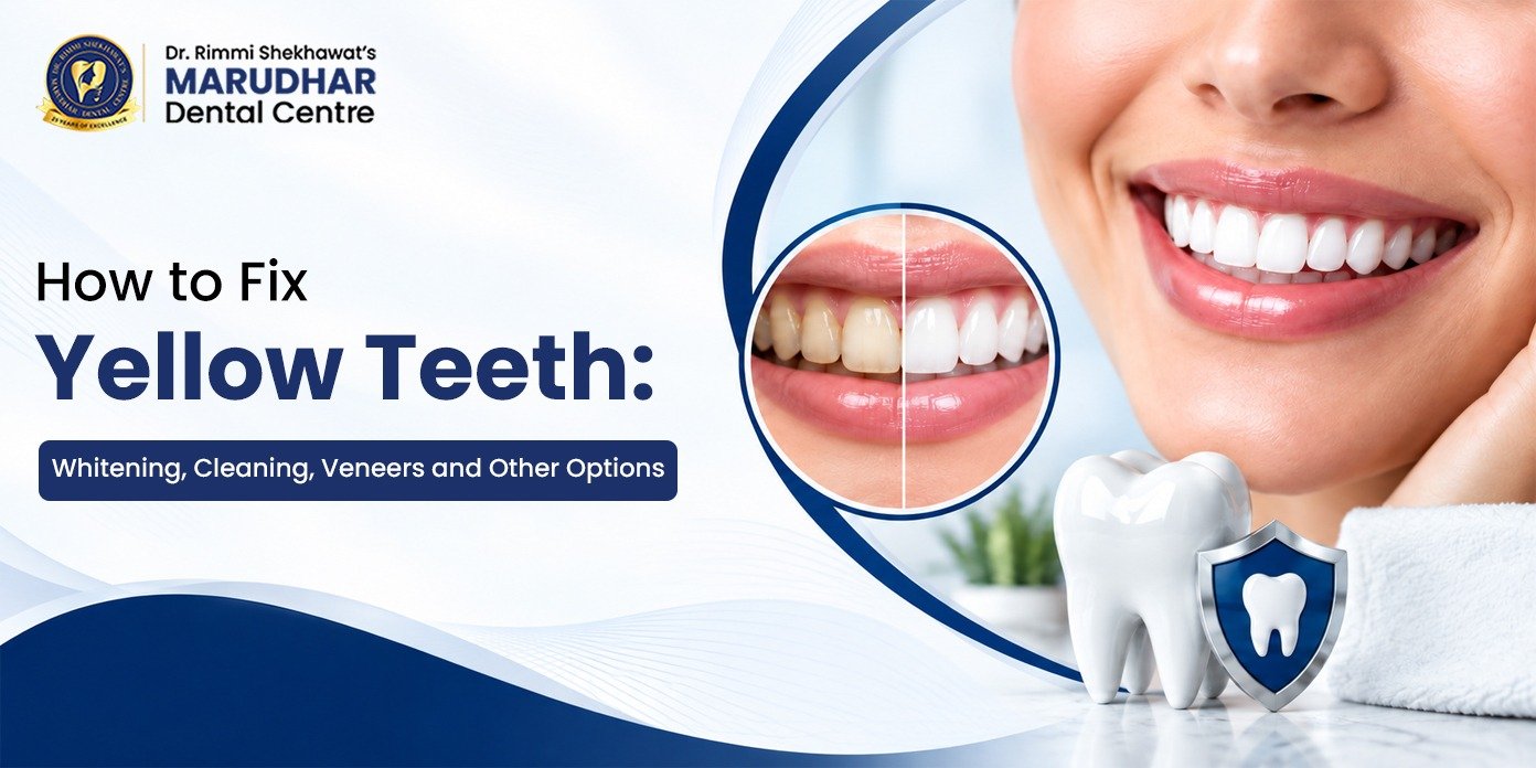 How to Fix Yellow Teeth: Whitening, Cleaning, Veneers and Other Options