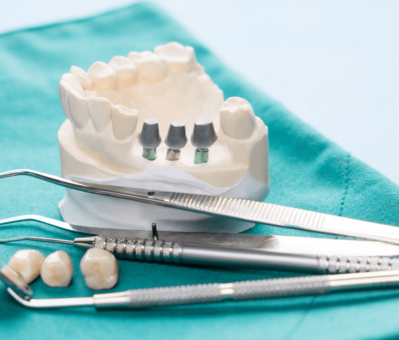 Dental implants course in jaipur