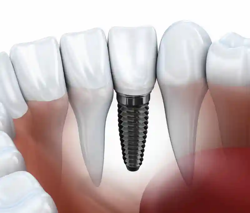 Single tooth implant and dental implants near me