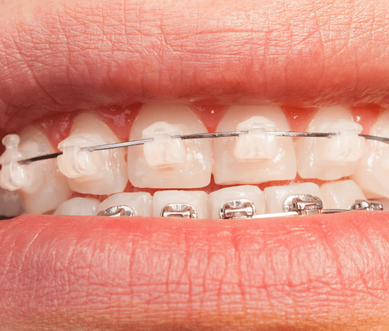 Braces Metallic or Tooth Colored Ceramic