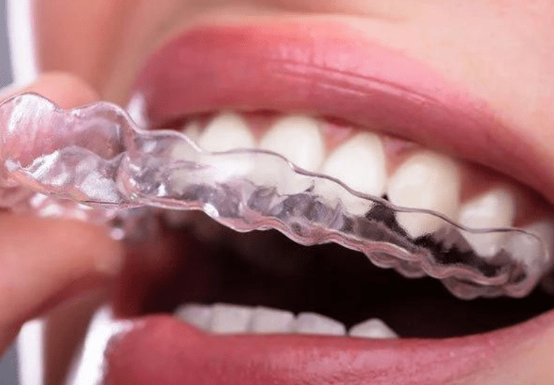 Clear Aligners Invisalign Braces