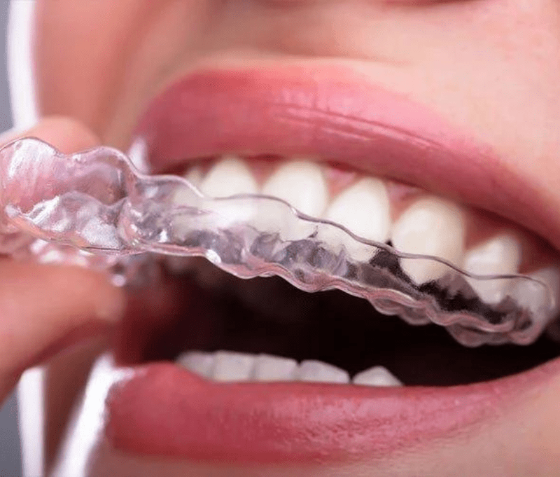 Clear Aligners,Invisalign Braces and best dental hospital in jaipur