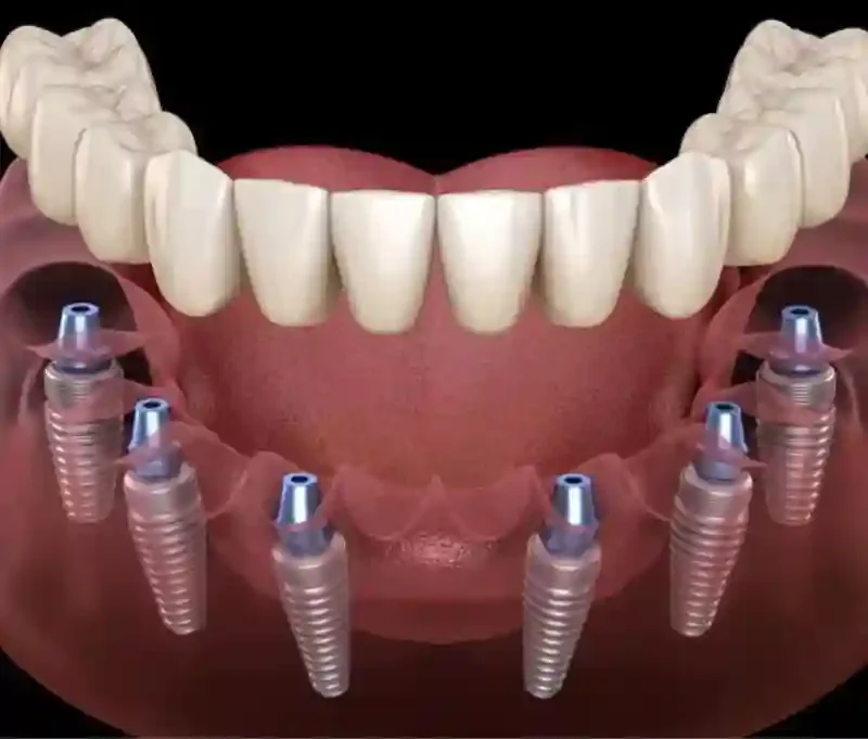 full mouth implant