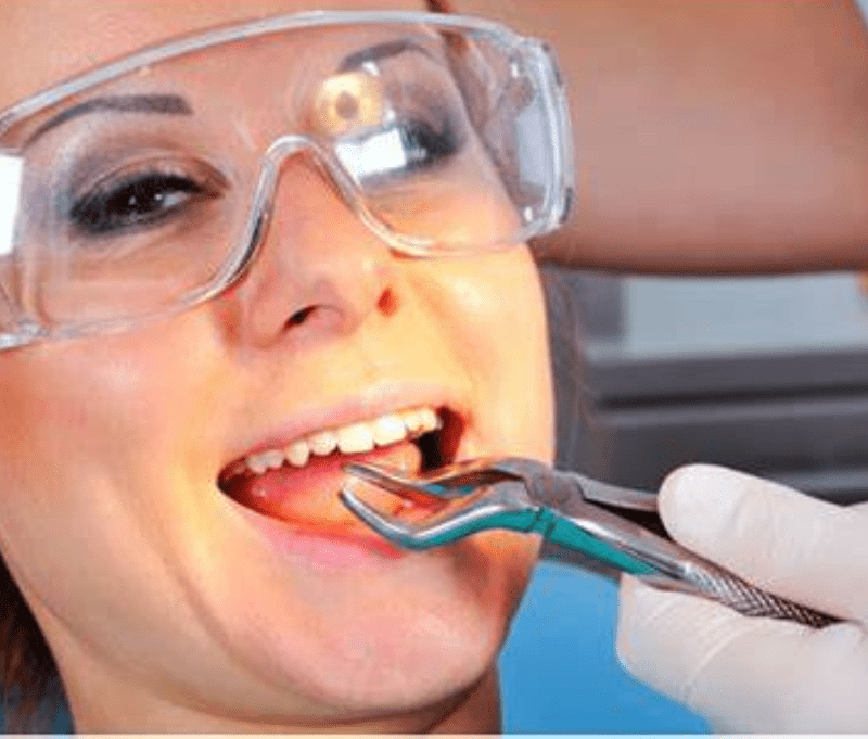 Simple & Surgical Tooth Extractions