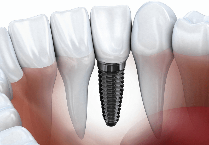Single tooth implant and dental implants near me